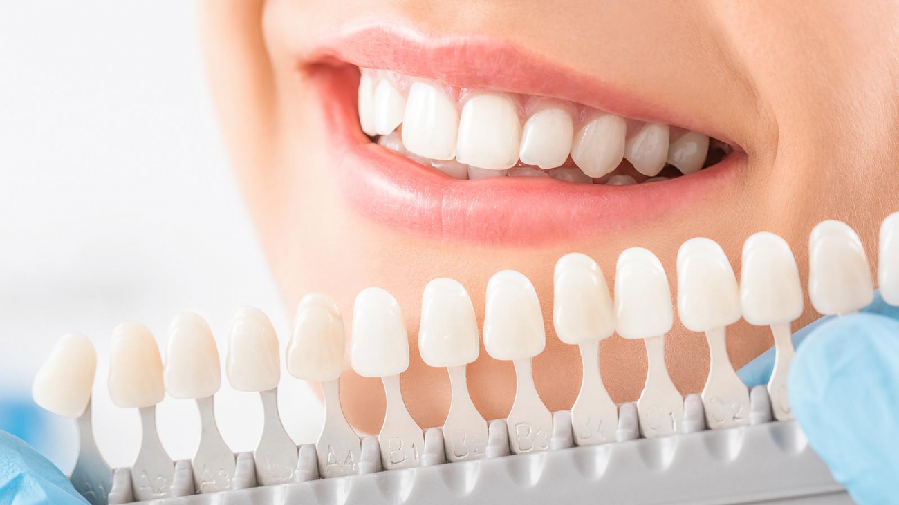 Esthetische tandheelkunde - Mijn tand tandarts hengelo