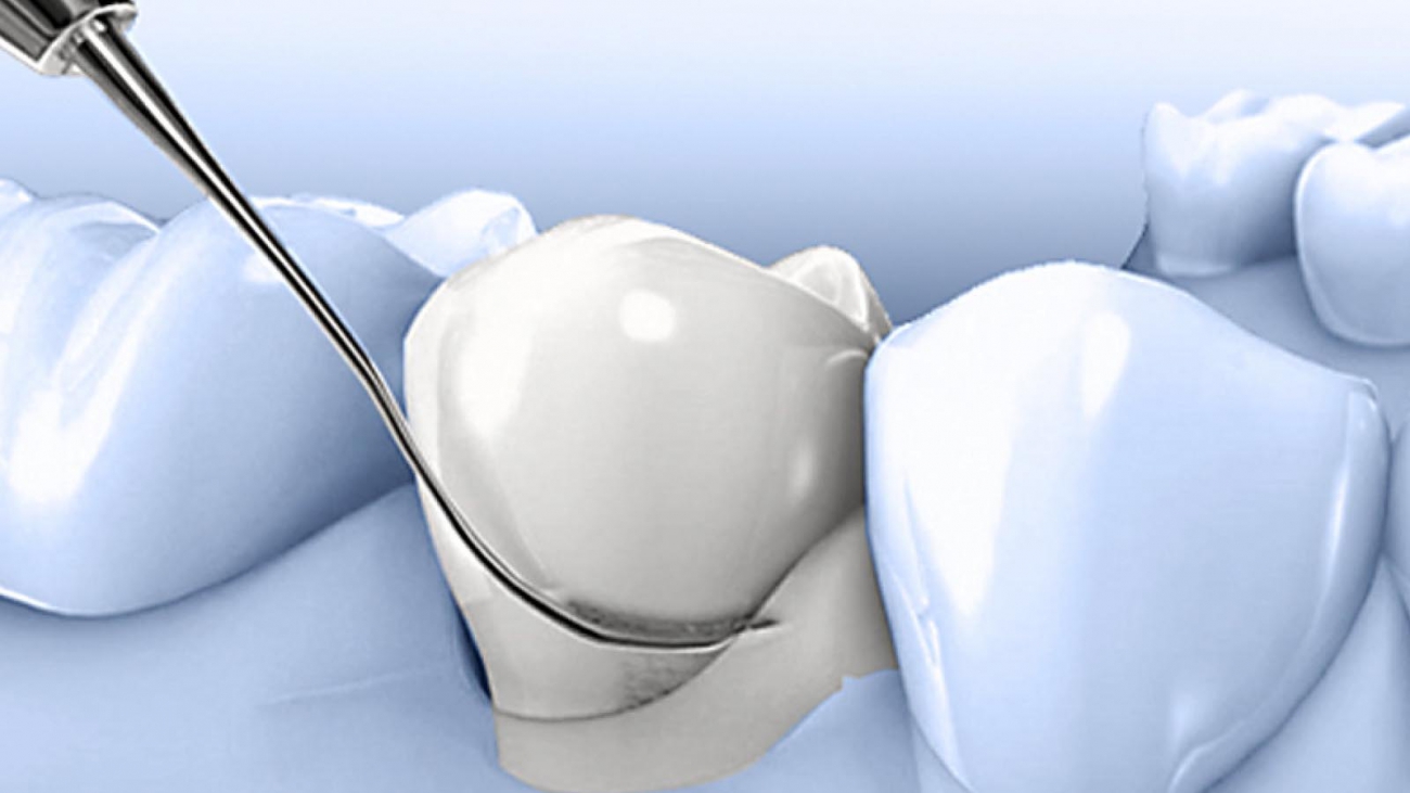 Paradontologie - mijn tand tandarts hengelo