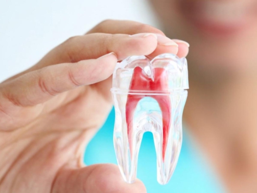 wortelkanaalbehandeling - Mijn tand tandarts hengelo